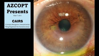 CAIRS Corneal Allogenic Intrastromal Ring Segment Case 1 [upl. by Ynffit]