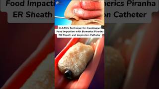 CLEANS Technique for Esophageal Food Impaction medical animation 3d short [upl. by Nogas94]