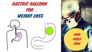 Stomach Balloon for Weight Loss [upl. by Asi]