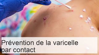 Peuton attraper la varicelle en côtoyant un enfant malade [upl. by Idur]