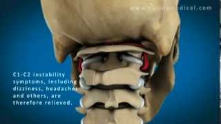 C1 and C2 Atlantoaxial Instability Upper Cervical Instability and Prolotherapy animation [upl. by Lednyc]