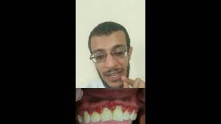 الفيديو الثالث في كورس Dental drugs Acute necrotizing ulcerative gingivitis [upl. by Alyl]