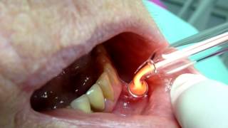 Canker Sores treatment Ozone DTA [upl. by Lerad]