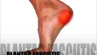 Plantar Fasciitis Diagnosis amp Treatment [upl. by Jahncke849]