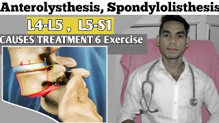 Anterolisthesis spondylolisthesis L5s1 spondylolisthesis Treatment Exercise Low back pain [upl. by Nirok]