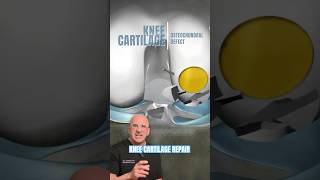 Knee Cartilage Divot Repair for Knee Pain Relief ⛳️ shorts [upl. by Pickering]