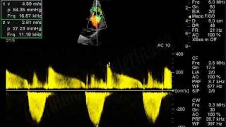 Stenosi polmonare canePulmonic stenosisCardiologia Veterinariaeuwmv [upl. by Sinnej]