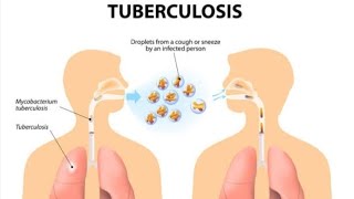 Tuberculosis symptomsdiagnosis treatment and pathogenesis [upl. by Afira550]