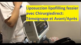 Chirurgie esthétique Tunisie  Liposuccion et lipofilling fesses avec un Avant AprèsChirurgieDirect [upl. by Sarena32]