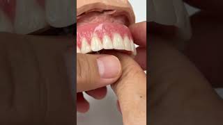 Removable denture [upl. by Aisaim]