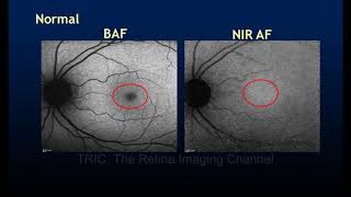 The Black amp White Fundus Images Red free Autofluorescence and Reflectance [upl. by Midis152]