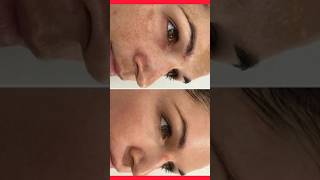 😍Remove dark spotsand pigmentationfine lines treatment at homeshorts skincareshortsfeed [upl. by Murielle325]