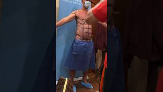 LEBO GYNO amp BEYOND FIXING BOTCHED GYNECOMASTIA 1 YEAR POST OP RESULTS [upl. by Suirad]