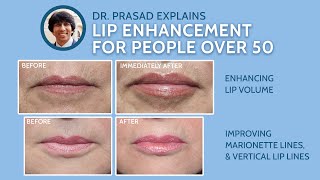 Why Lip Enhancement Over Age 50 Needs More than Lip Fillers [upl. by Guendolen]