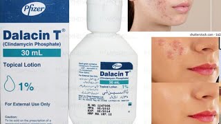 Dalacin T lotion remove acne Clindamycin phosphate  review [upl. by Imoian]