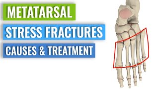 Metatarsal Stress Fractures  Causes Treatment Prevention [upl. by Enirehs]