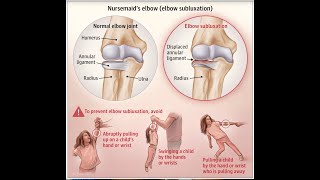 Signs and Prevention of Nursemaids Elbow [upl. by Arick]