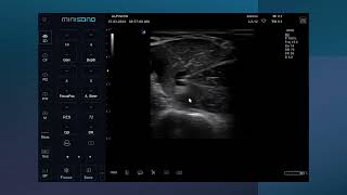 Ultrasound guided Axillary brachial plexus nerve block [upl. by Scoter461]