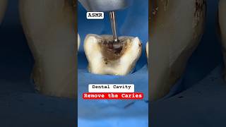 Remove the Caries cavity teethsmiledrmassidental [upl. by Ahsurej221]