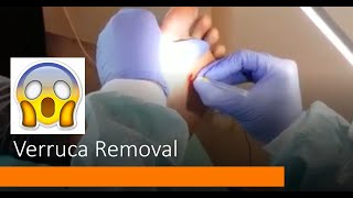 Verruca Needling Curing a 10 year Verruca Verruca Removal  Abid Hussain Podiatrist [upl. by Litta]