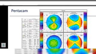 pentacam 1منالاخر [upl. by Gault]