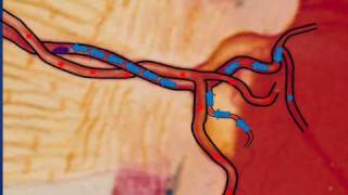 What is Central Retinal Vein Occlusion CRVO [upl. by Lapotin]