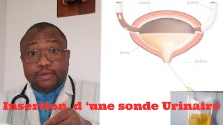 Comment installer une sonde urinaire en 3 etapes simples [upl. by Buyse]