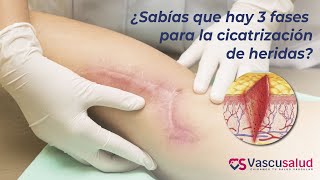 ¿Sabías qué hay 3 fases de cicatrización para las heridas  Vascusalud [upl. by Cran695]