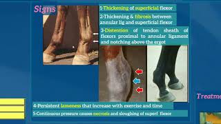 9Constriction of palmar volar or planter annular ligament [upl. by Janus]