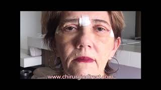 Chirurgie esthétique Tunisie La blépharoplastie ou chirurgie des paupières [upl. by Christen]