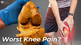 How Arthritis Destroys Your Knees [upl. by Inatirb]