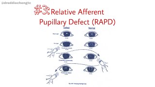 How To Perform Relative Afferent Pupillary Defect [upl. by Bree]