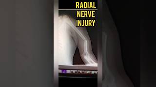 Radial Nerve Injury after Humerus Fracture Wrist amp Finger Drop  Dr Prateek Joshiortho fracture [upl. by Elamor269]