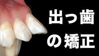 出っ歯 buck teeth GVBDO Before amp After Braces Time Lapse 410 Days 醜い容貌と顎関節症 TMDを治し完全復活した歯列矯正 [upl. by Atilahs]