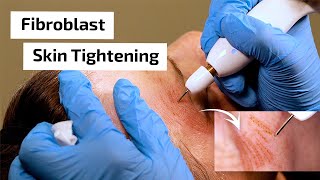 What is Fibroblast Skin Tightening  Prime Plasma [upl. by Leiria595]