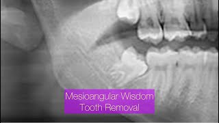 Mesioangular Wisdom Tooth Removal Step by Step drwahan DrWahanExperiment [upl. by Cummings421]