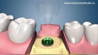 Dental Implants Step by Step Procedure [upl. by Nuahsak]