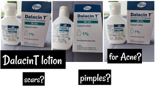 Dalacin T lotion Review Acne pimples ampscars [upl. by Ahsaeyt]