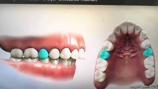 What happens when teeth are removed for Invisalignwhy extractions for orthodontics is harmful [upl. by Lerrad]