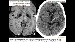 67 Radiation induced cavernoma and mineralising microangiopathy popcorn capillary teleangiectasia [upl. by Amling]