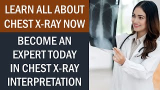 Learn Everything About Chest Xray Now  Become An Expert in CXR Interpretation [upl. by Haelhsa61]