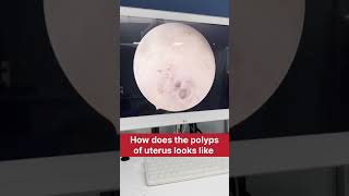 How does the polyps of uterus looks like doctor ivfdoctor doctorlife mbbs medicaldoctor ivf [upl. by Mazman710]