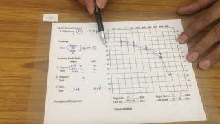 Common Audiograms in ENT [upl. by Amla289]