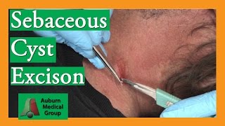 Sebaceous Cyst Removal  Auburn Medical Group [upl. by Anauqahc]