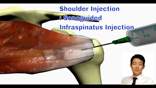 Shoulder Injection Therapy The Ultrasoundguided Approach for Infraspinatus [upl. by Sandberg]