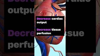 How to ace Cardiac Tamponade in nursing school and NCLEX nursingschooltips [upl. by Llenod]