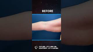 Brachioplasty Armlift Plastic surgery Kandy Sri Lanka Dr Ananda Jayawardena cosmeticsurgery [upl. by Tlok]