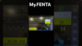 TAQUI DE QRS ESTREITO COM INSTABILIDADE HEMODINAMICA [upl. by Noyart]