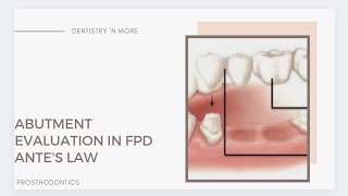 ABUTMENT SELECTION IN FPD [upl. by Idram]