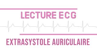 Interprétation ECG  Extrasystole Auriculaire quotESAquot [upl. by Hemetaf]